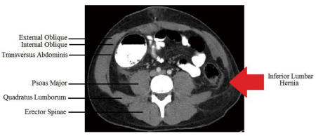 Repair of a Traumatic Lumbar Hernia With Biosynthetic Mesh: A Novel