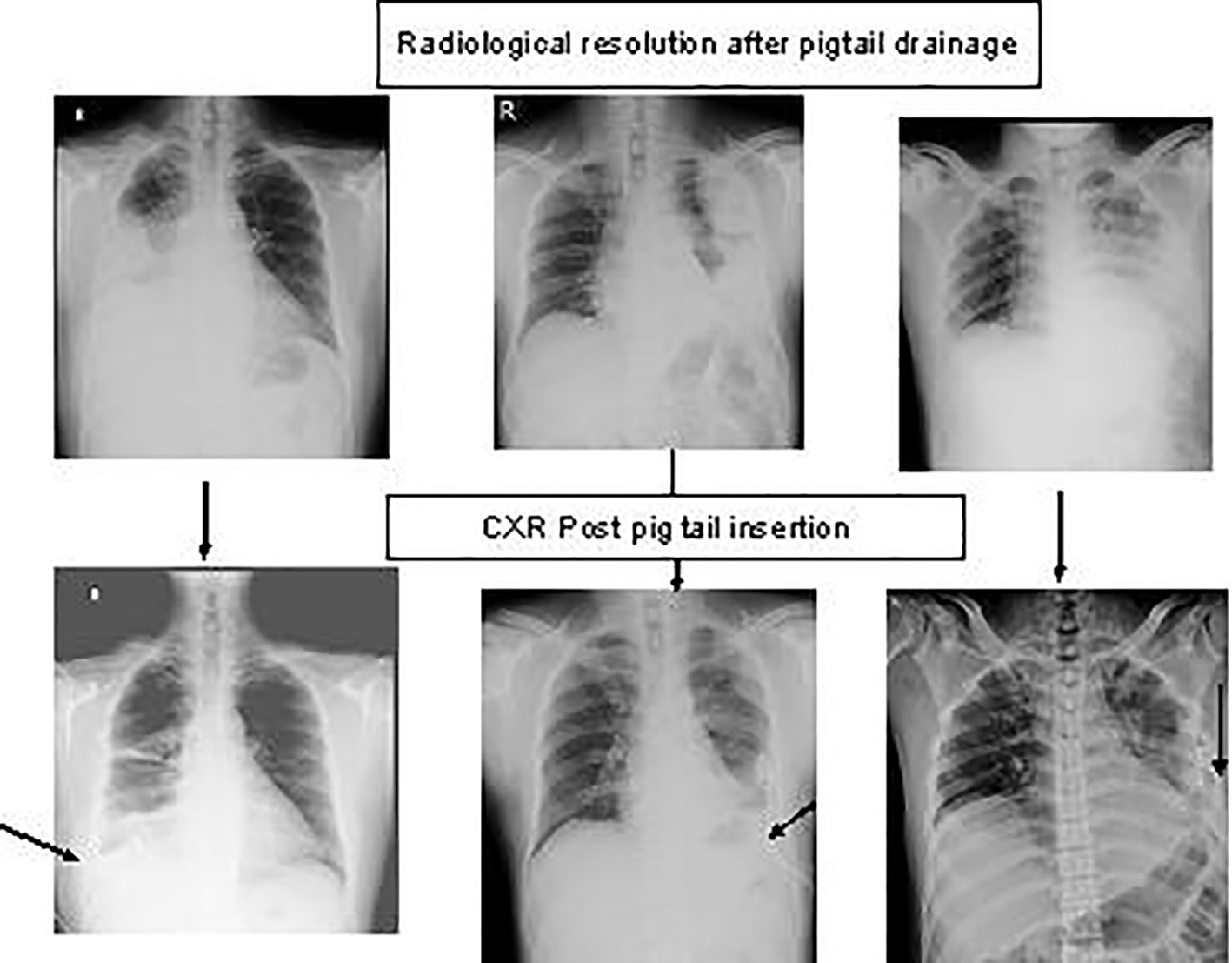 pigtail catheter pneumothorax