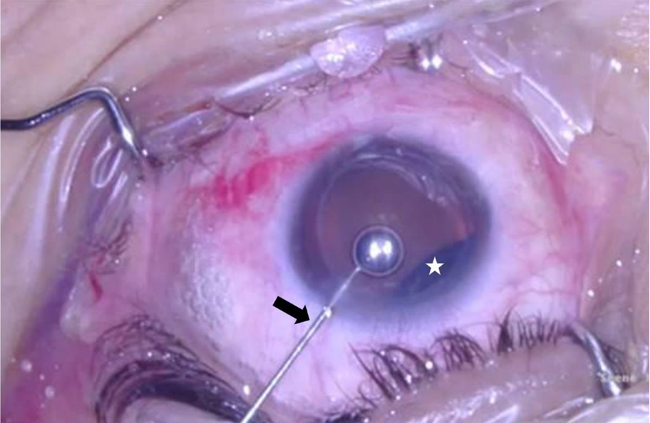 bubble in eye after retina surgery